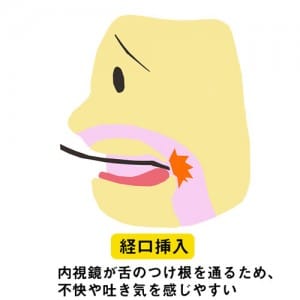 経口挿入 内視鏡が舌のつけ根を通るため、不快や吐き気を感じやすい