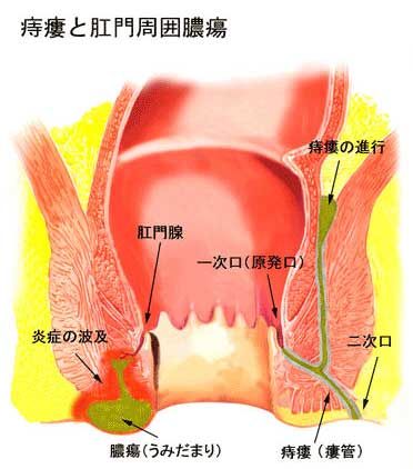 痔ろう あな痔 と肛門周囲膿瘍 岡外科胃腸肛門科