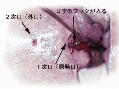 肛門腫瘍2