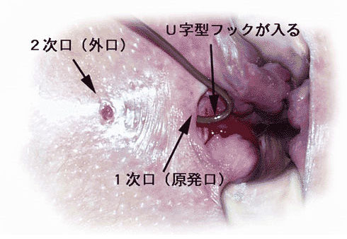 膿瘍 肛門 周囲 肛門周囲膿瘍とは？症状や原因、治療方法を紹介！