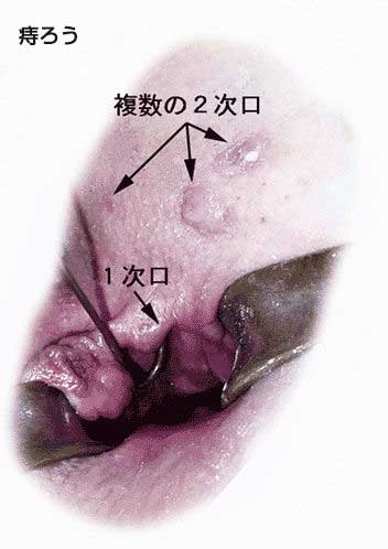 痔ろう あな痔 と肛門周囲膿瘍 岡外科胃腸肛門科