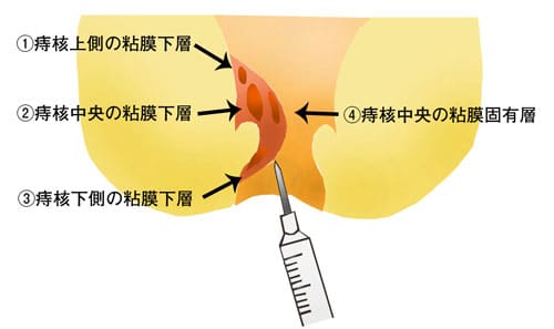 注射 後遺症 ジオン